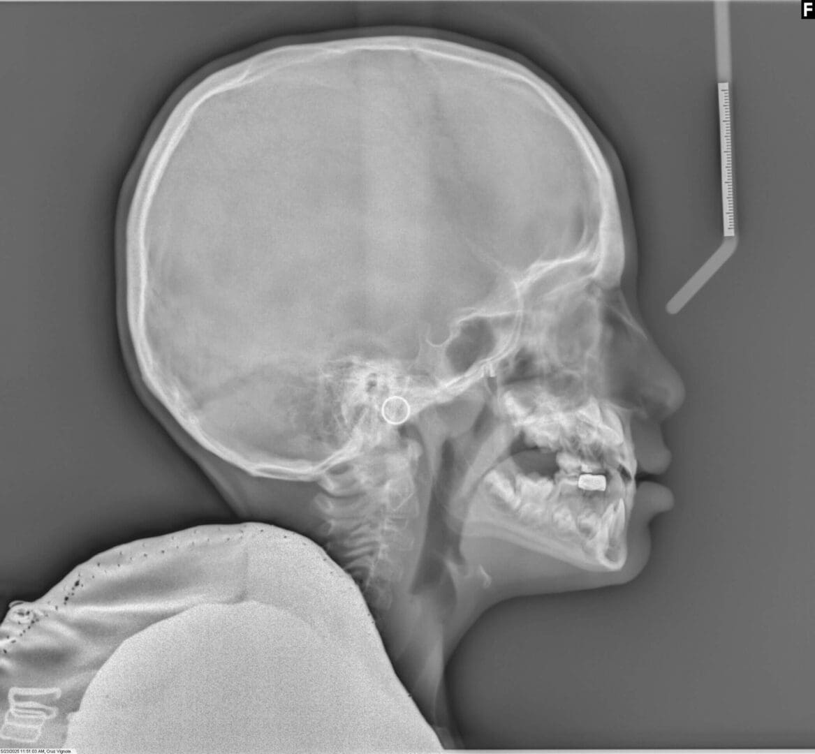 Lateral X-ray of a child's skull showing dental and cranial structures.