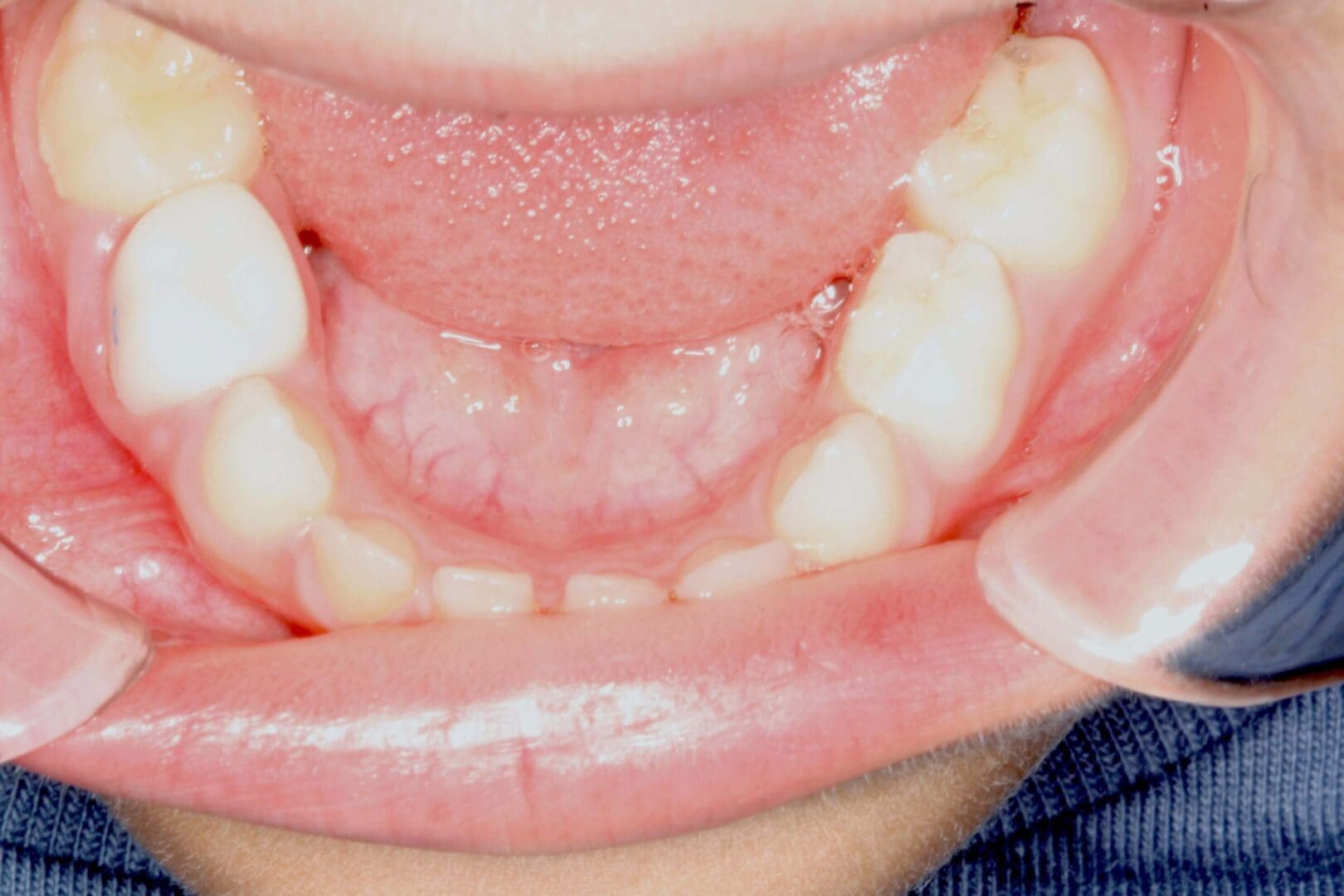 Close-up of a child's lower teeth and gums with visible dental development.