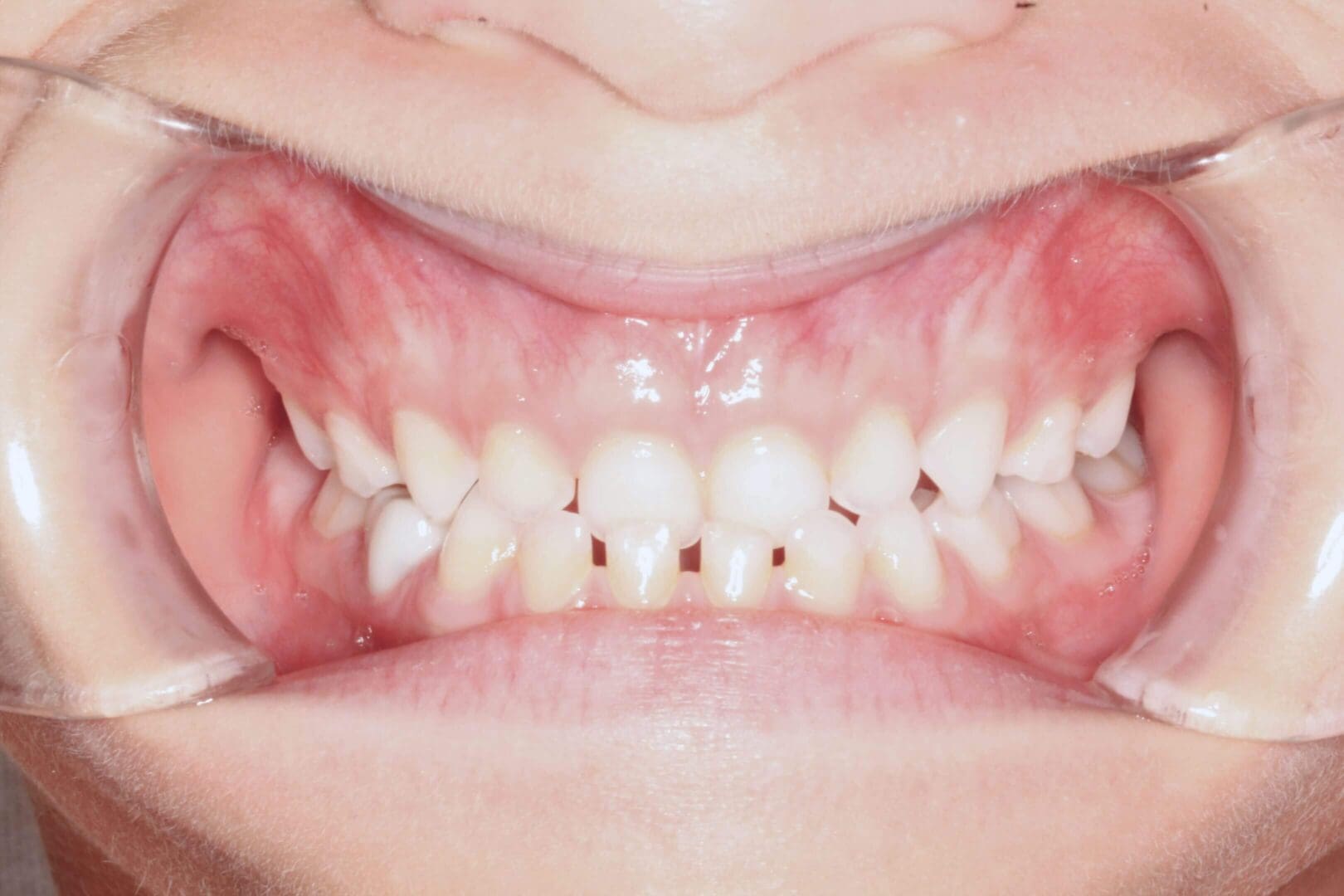Close-up of a child's upper front teeth with dental crowding.