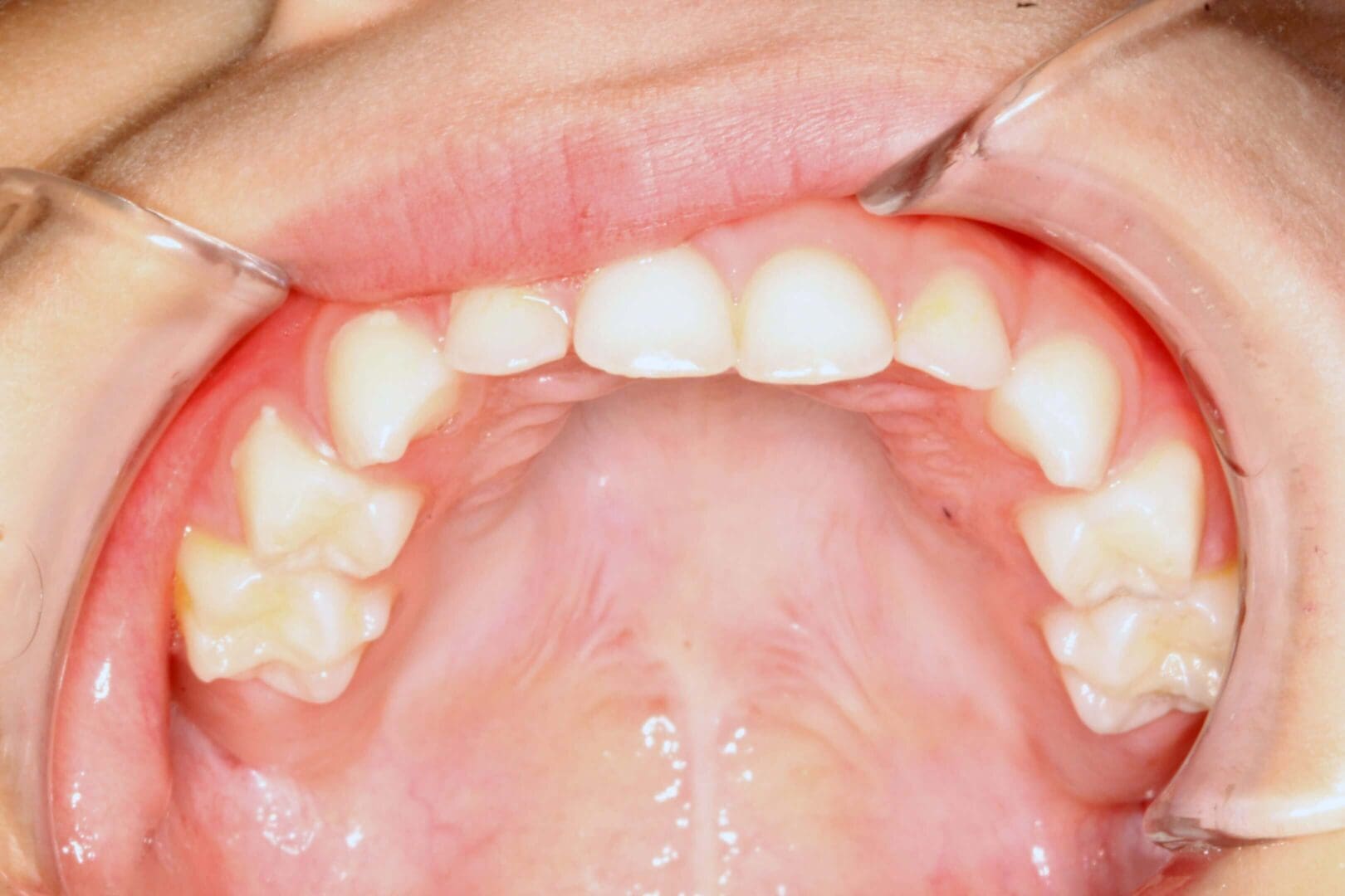Close-up of upper teeth and palate inside the mouth.