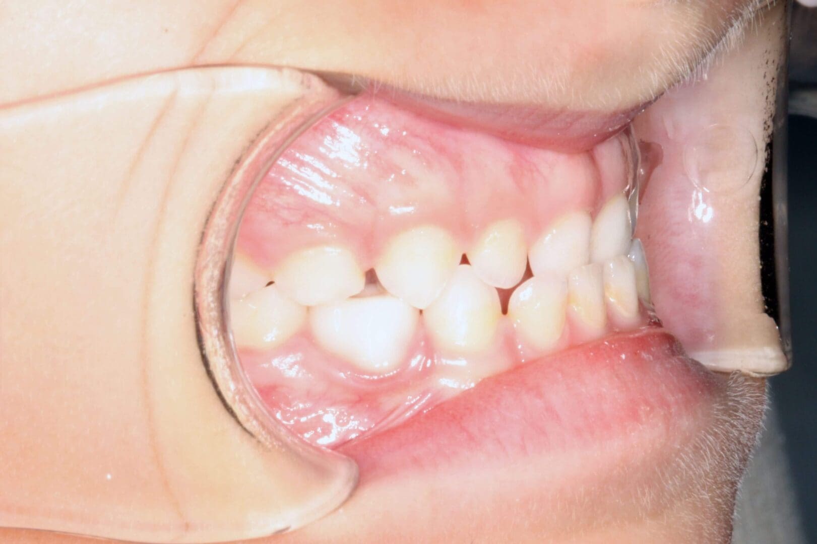 Close-up of a person's teeth with dental cheek retractor in place.