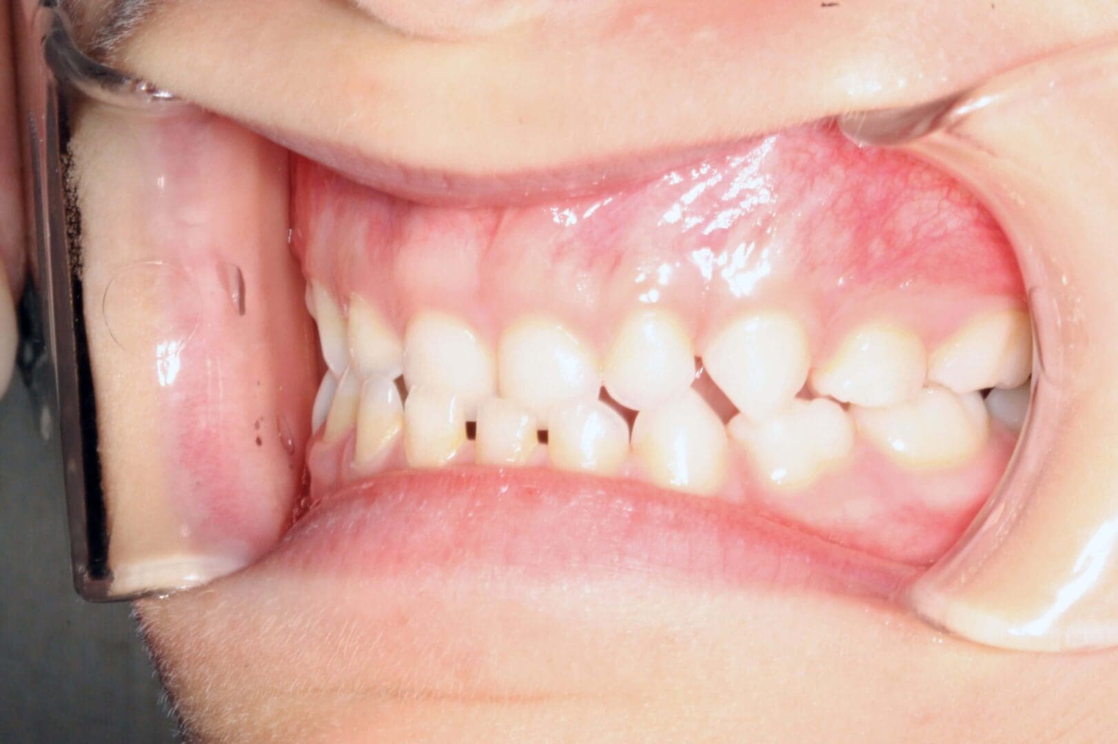 Close-up of teeth with visible black spots on molars.