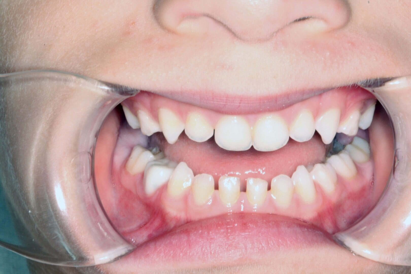 Close-up of a mouth showing teeth with dental retractor.