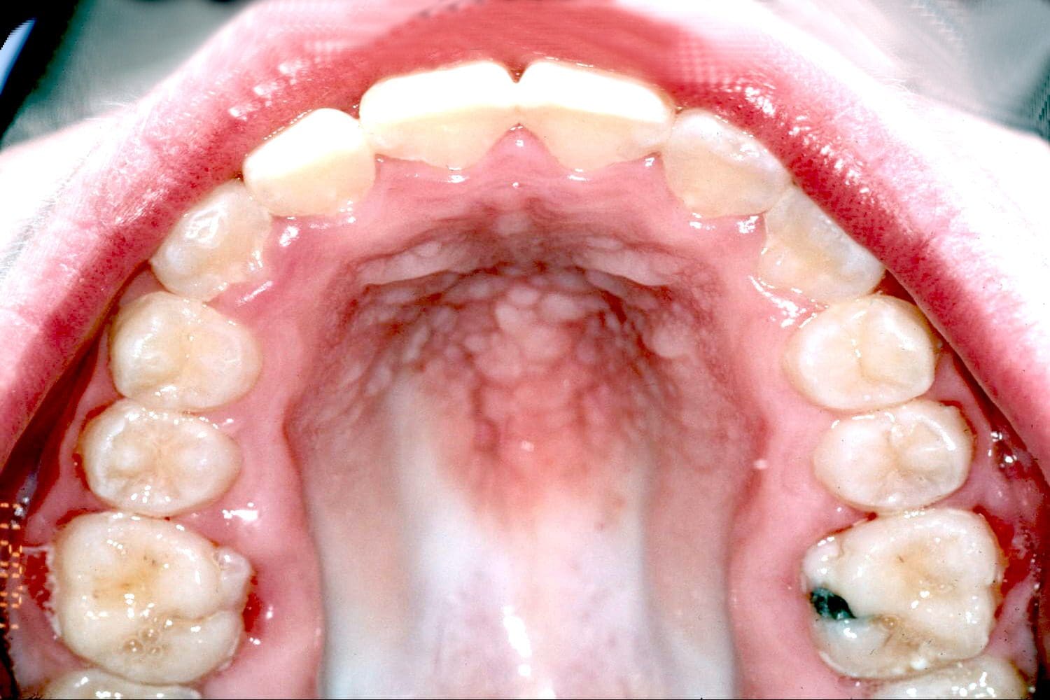 Close-up of the upper palate and teeth inside a mouth.
