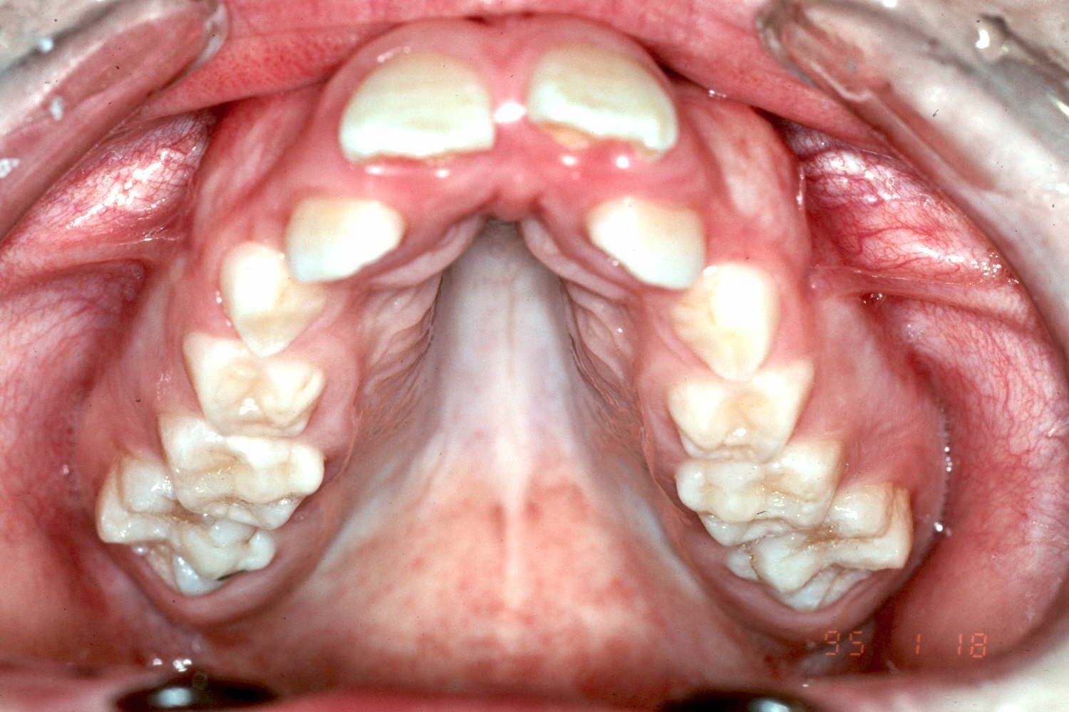 Close-up of upper palate showing dental crowding and misalignment.