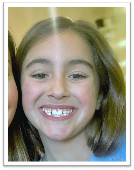 Smiling young girl with missing front teeth.