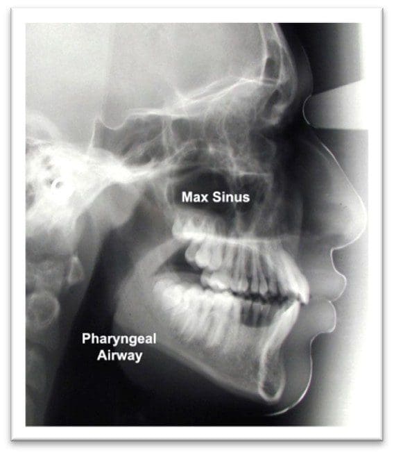 Lateral X-ray showing maxillary sinus and pharyngeal airway.