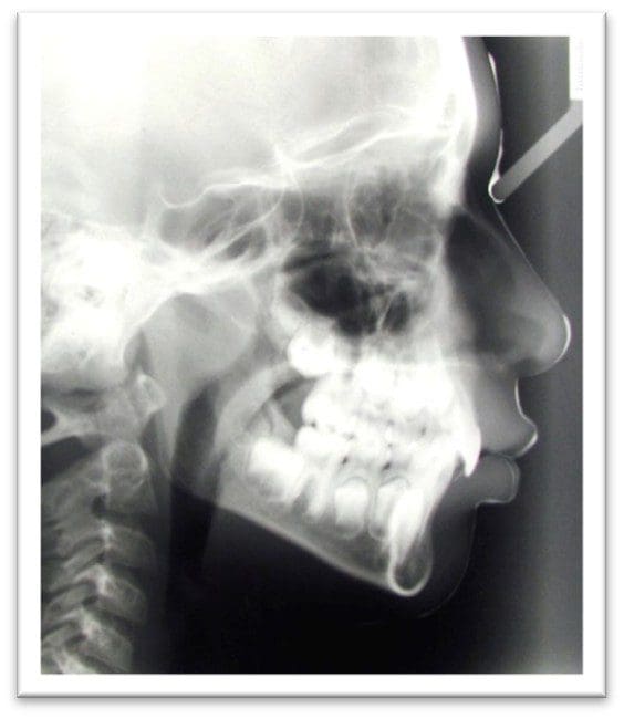 Lateral X-ray of a human skull showing jaw and teeth alignment.